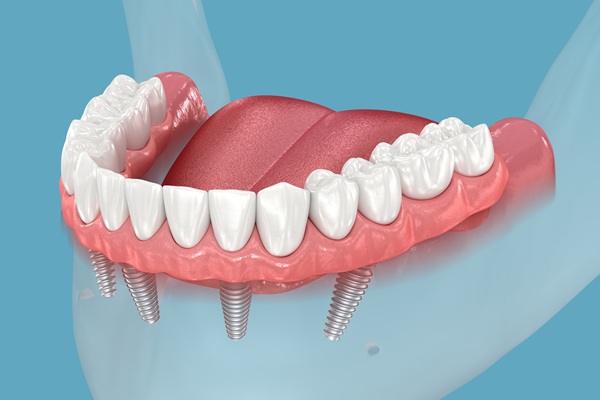 All On   Is An Implant Supported Dentures Option