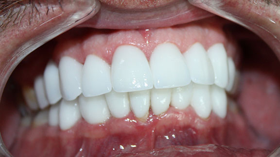Full Mouth Reconstruction AFter