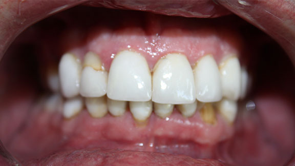 Full Mouth Reconstruction Before