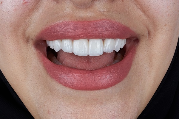 How Dental Bonding Can Minimize Gaps Between Teeth