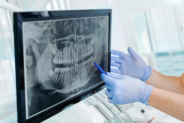 A General Dentistry Explains The Uses For X Rays