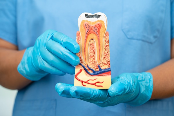 Can Multiple Teeth Need A Root Canal?