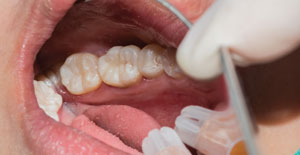 Dental fillings